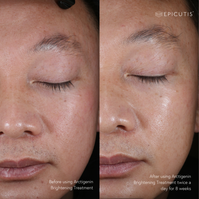 Epicutis Before & Afters - Arctigenin Brightening Treatment