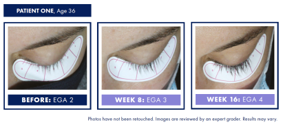 Nu-Cil Before & After 1