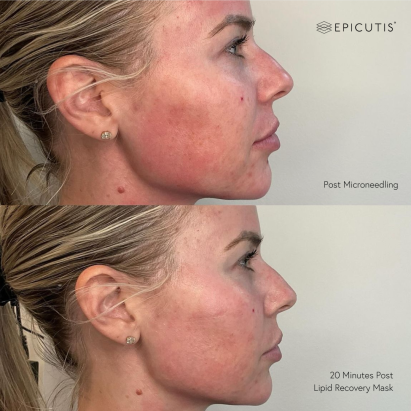 Epicutis Before & Afters - Lipid Recovery Mask 1% TSC