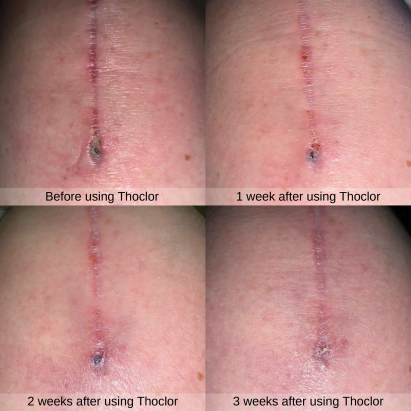 Thoclor Before and After GF1 (1)