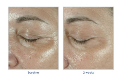 ELASTIderm Before & After 1