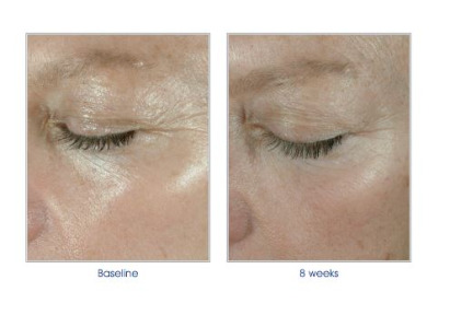 ELASTIderm Before & After 3