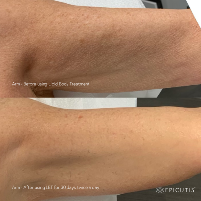 Epicutis Before & Afters - Lipid Body Treatment