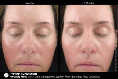 Before & Afters – Hyperpigmentation