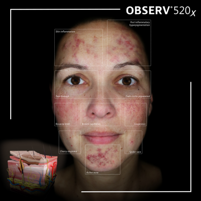 OBSERV® 520x Skin 3D Visuals