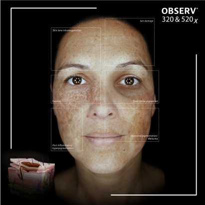 OBSERV® 320 3D Skin Visuals