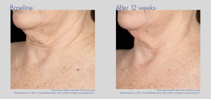 ELASTIderm Neck and Décolleté Before & After 1