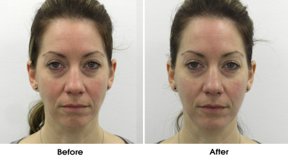 ULTRAcel Before & After 1