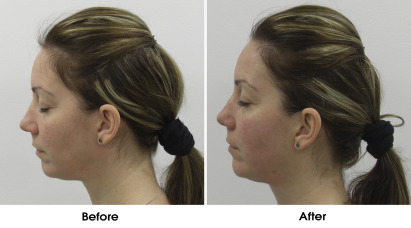 ULTRAcel Before & After 3