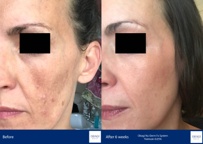 Before and After - Nu-Derm Fx