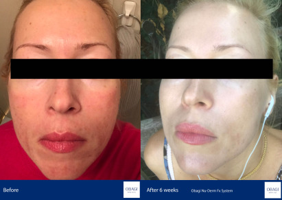 Before and After - Nu-Derm Fx