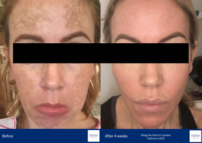 Before and After - Nu-Derm Fx