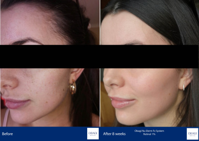 Before and After - Nu-Derm Fx