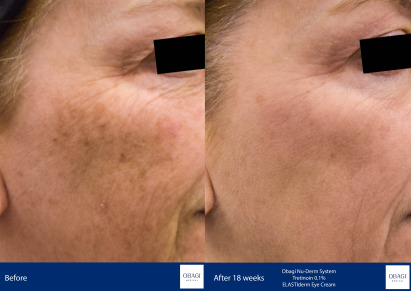 Before and After - ELASTIderm