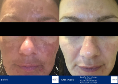 Before and After - Nu-Derm Fx