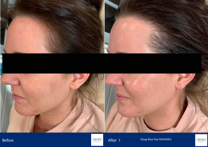 Before and After - Blue Peel RADIANCE