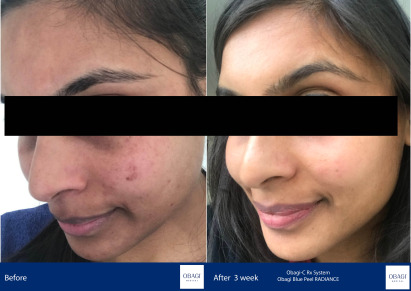 Before and After - Blue Peel RADIANCE