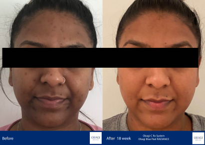 Before and After - Blue Peel RADIANCE