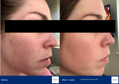 Before and After - Blue Peel RADIANCE