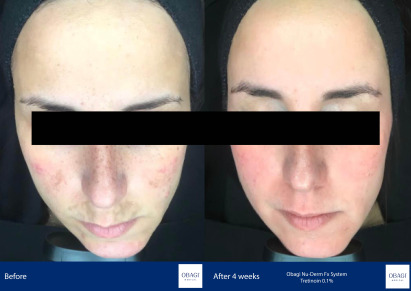 Before and After - Nu-Derm Fx