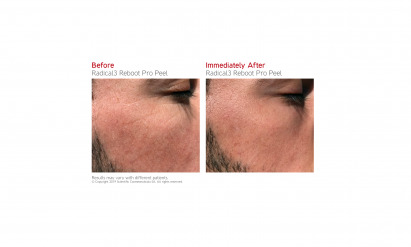 Dr LEVY Before and After 10 - Radical3 Peel