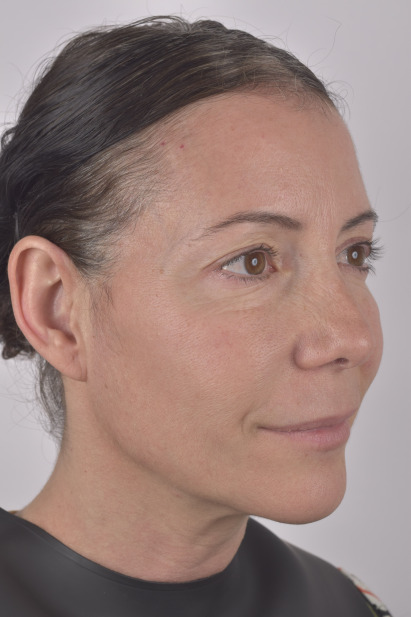 Pro Collagen+ - Before & Afters