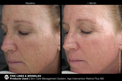 Before & Afters – Fine Lines & Wrinkles