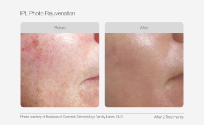 UltraLUX PRO Before & Afters - IPL Photo Rejuvenation