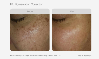 UltraLUX PRO Before & Afters - IPL Pigmentation Correction
