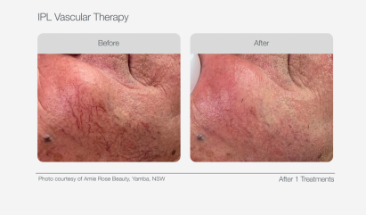 UltraLUX PRO Before & Afters - IPL Vascular Therapy