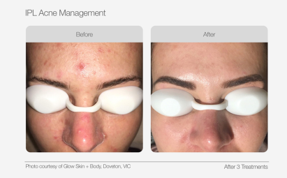 UltraLUX PRO Before & Afters - IPL Acne Management