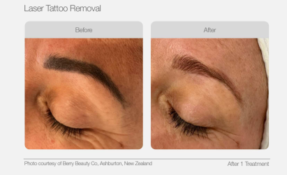 UltraLUX PRO Before & Afters - Laser Tattoo Removal