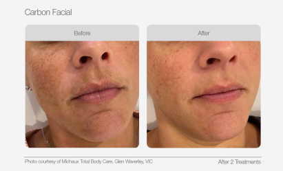 UltraLUX PRO Before & Afters - Carbon Facial