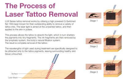 UltraLUX PRO The Process of Laser Tattoo Removal Poster