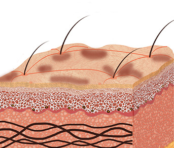 Signs of Hyperpigmentation