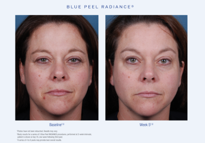 Blue Peel Radiance Before and After 1