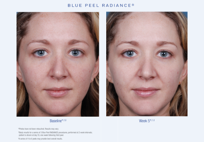 Blue Peel Radiance Before and After 2