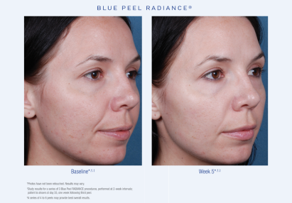 Blue Peel Radiance Before and After 3