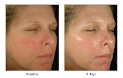 Obagi Blue Peel RADIANCE Before and After