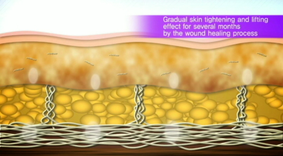 ULTRAcel Skin Layers